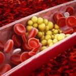 Hipertrigliceridemia