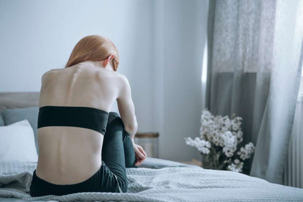 Anorexia nerviosa