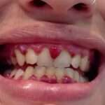 Deficiencia de vitamina C