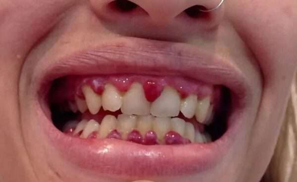 Deficiencia de vitamina C