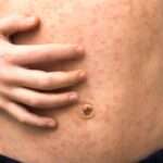 Varicela (viruela loca) y Herpes Zóster (culebrilla)