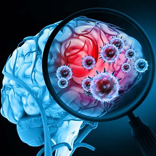 Encefalitis por arbovirus