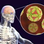 Encefalitis Japonesa