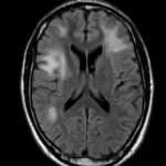 Leucoencefalopatía Multifocal Progresiva