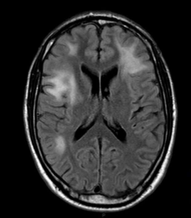 Leucoencefalopatía Multifocal Progresiva