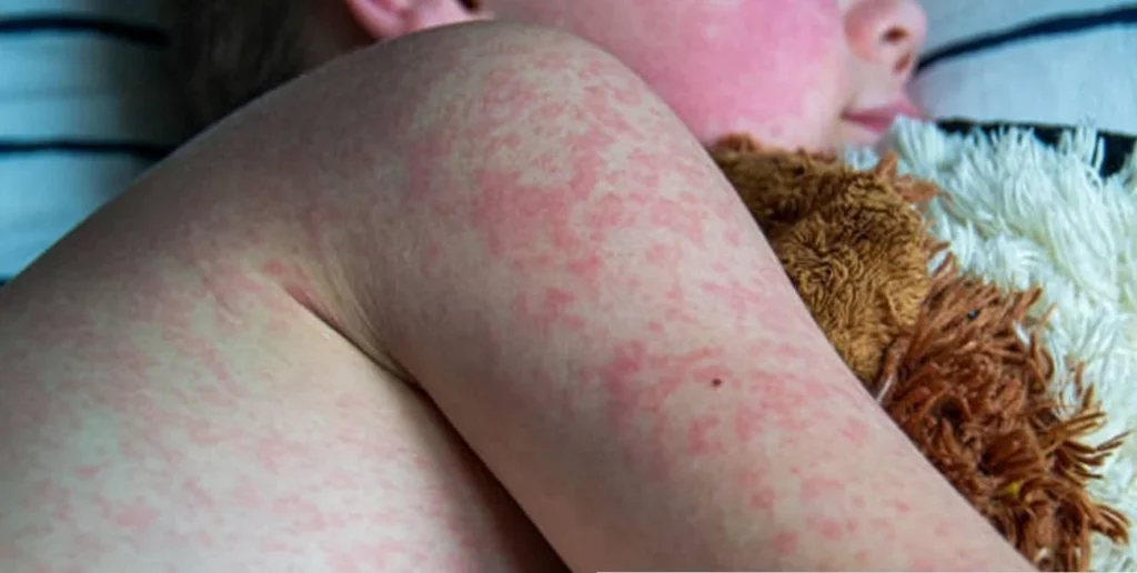 Infecciones por Eritroparvovirus