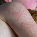 Infecciones por Eritroparvovirus