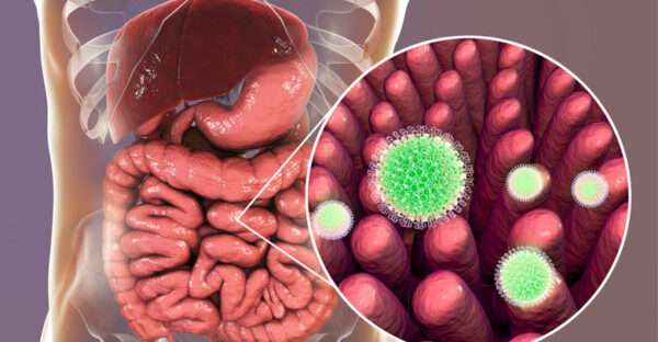 Gastroenteritis causada por virus