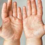 Síndromes causados por la infección por el Coxsackievirus