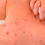 Fiebre manchada de las Montañas Rocosas