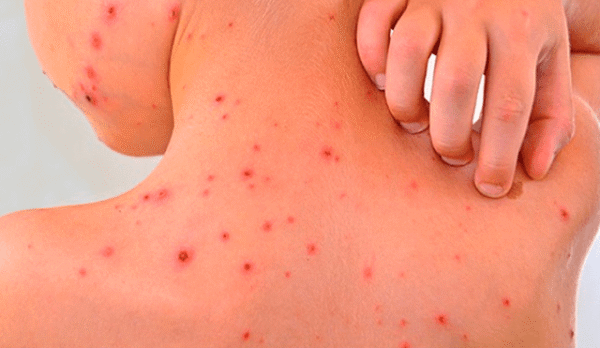 Fiebre manchada de las Montañas Rocosas