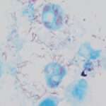 Fiebre Tifoidea por Garrapatas (Fiebre Rickettsial)