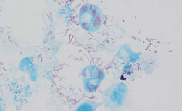 Fiebre Tifoidea por Garrapatas (Fiebre Rickettsial)