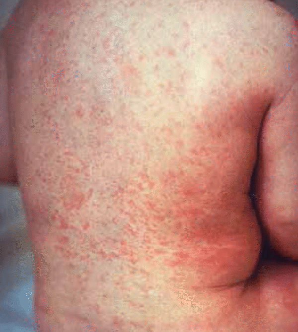 Enfermedad de Kawasaki