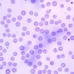 Ehrlichiosis y Anaplasmosis