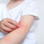 Infecciones cutáneas por estreptococos