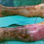 Fascitis Necrotizante