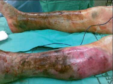 Fascitis Necrotizante