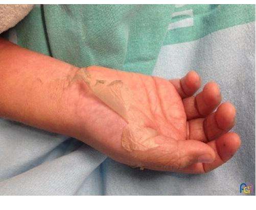 Síndrome de choque tóxico