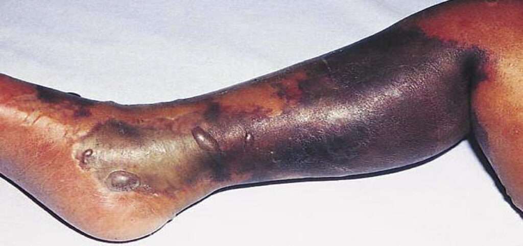 Mionecrosis clostridial (Gangrena gaseosa)