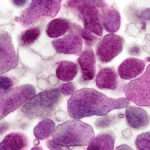 Infecciones por Mycoplasma genitalium