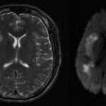 Meningitis tuberculosa