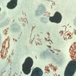 Lepra (Enfermedad de Hansen)