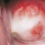 Uretritis y Cervicitis por Clamidia