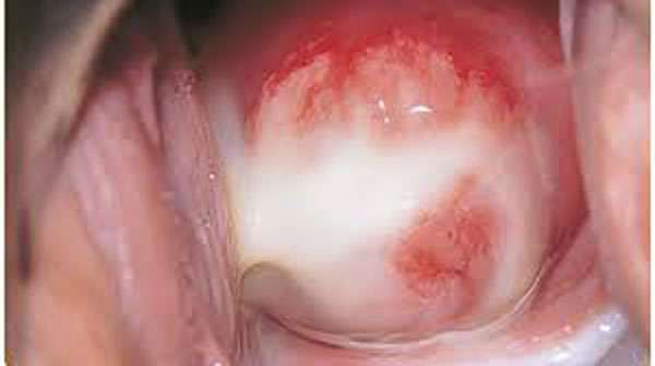 Uretritis y Cervicitis por Clamidia