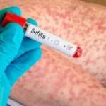 Historia natural y principios del diagnóstico y tratamiento de la sífilis