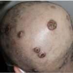 La sífilis terciaria (sífilis sintomática tardía)