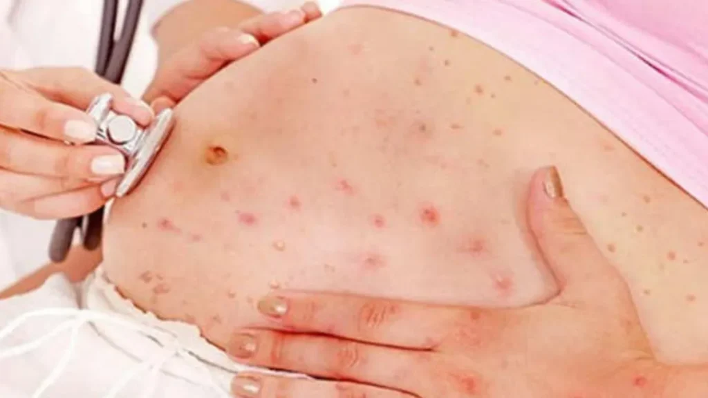 Sífilis en el embarazo