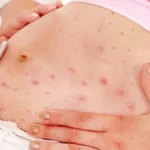 Sífilis en el embarazo