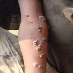 ¿Qué es la frambesía?