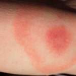 Enfermedad de Lyme (Borreliosis de Lyme)