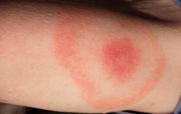 Enfermedad de Lyme (Borreliosis de Lyme)