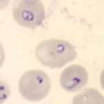 Babesiosis