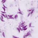 Toxoplasmosis