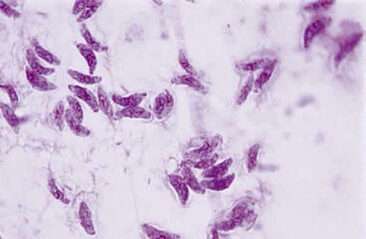 Toxoplasmosis