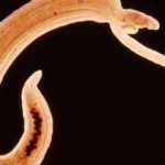 Esquistosomiasis (Bilharziasis)