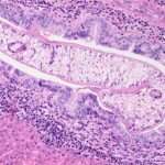 Clonorquiasis y Opistorquiasis