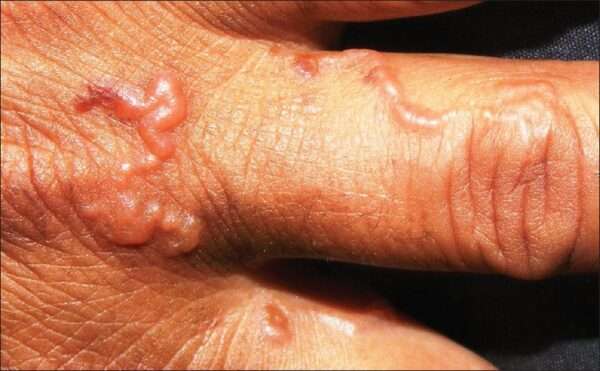 Larva migrans cutánea (Erupción serpiginosa)