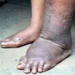 Filariasis linfática