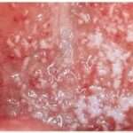 Candidiasis