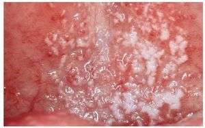 Candidiasis