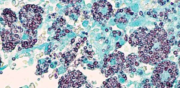 Histoplasmosis