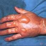 Quemaduras térmicas