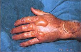 Quemaduras térmicas