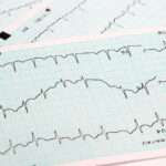 Arritmias causadas por intoxicación o sobredosis