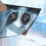 Tratamiento del cáncer broncogénico